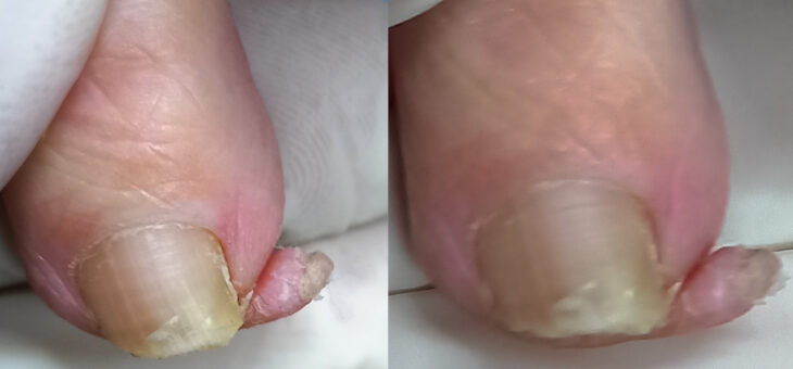 Интересное Фиброзное Образование На Пальце (не мозоль)