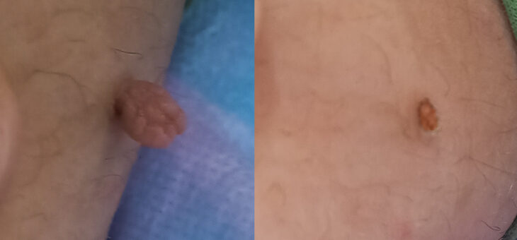 Акрохордонома в Паху: Опасно Или Нет