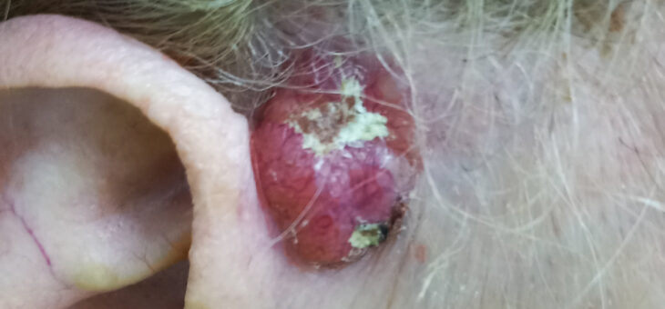 Базалиома Около Уха