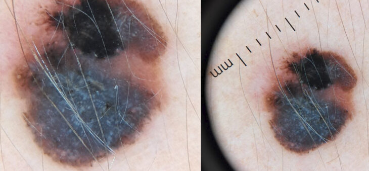 Дерматоскопия: Зачем и Когда?