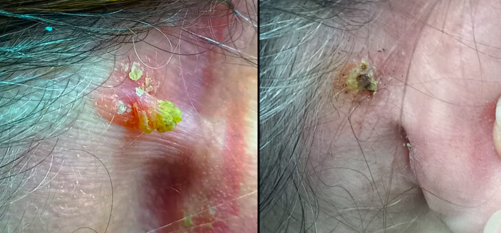 Роговая Кератома- Что Это?