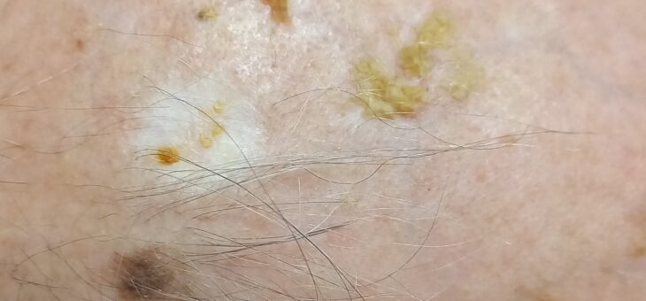 Актинический Кератоз в ПМР