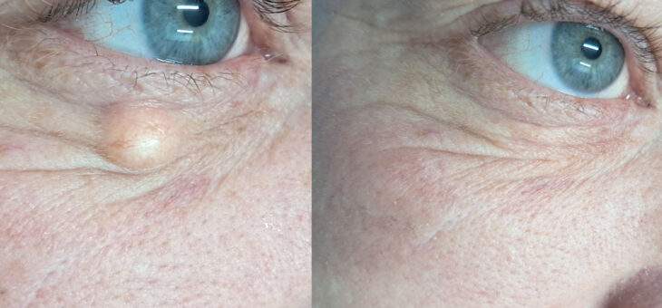 Большой Миллиум Под Глазом