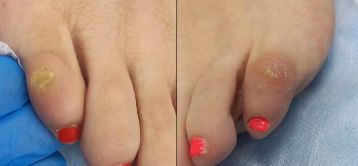 Стержневые Мозоли и Как с Ними Бороться