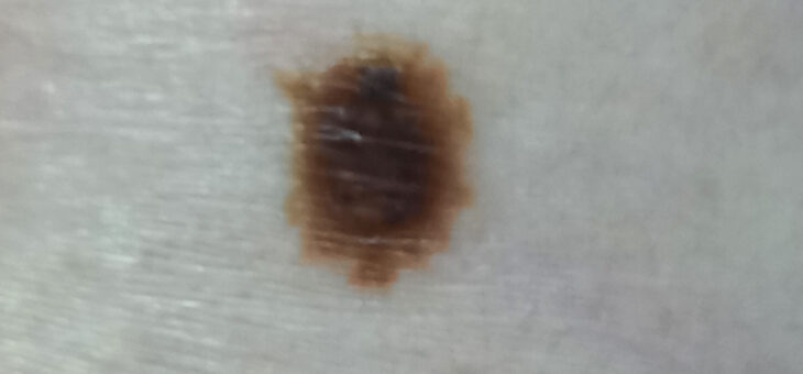 Меланоцитарный Невус Смешанного Типа