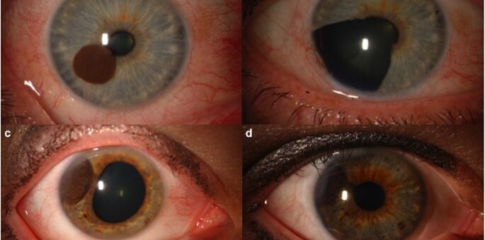 Меланома Глаза Или Увеальная Меланома