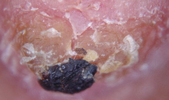 Рак Молочной Железы Педжета: симптомы, стадии и лечение