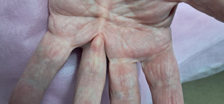 Контрактура Дюпюитрена или Почему Стягиваются Пальцы