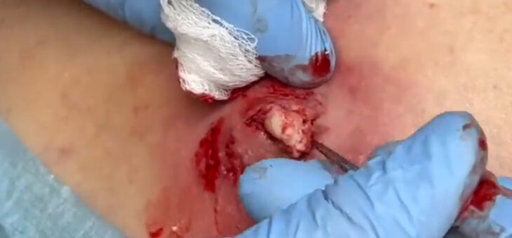 Что Такое Дермальная Киста и Как Удалить !!!