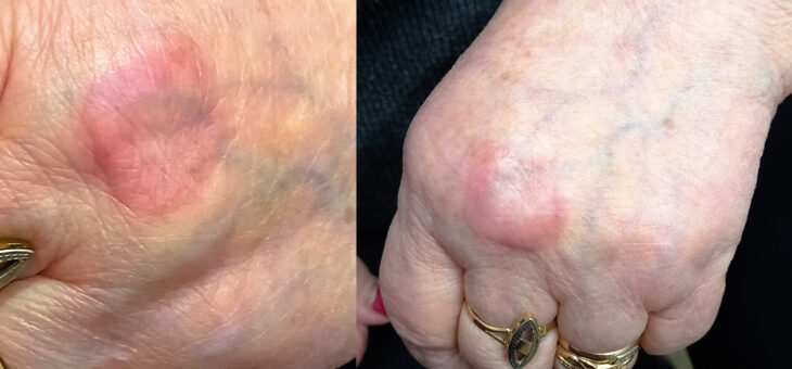 Кольцевидной Гранулёма: Причина и Лечение