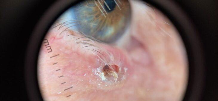 Кератоакантома- Что Это ?