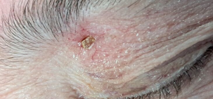 Кератоакантома- Опасно или Нет ?