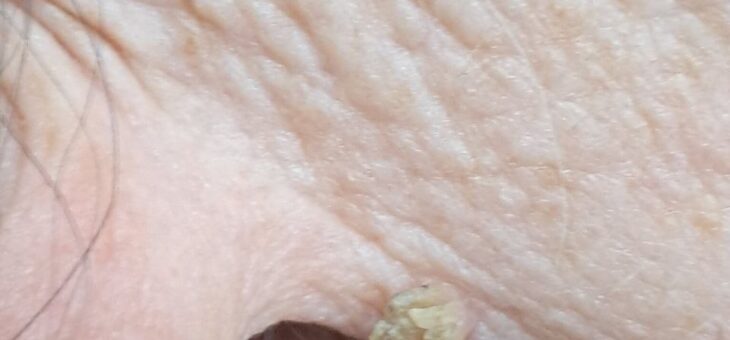 Роговая Кератома!!!