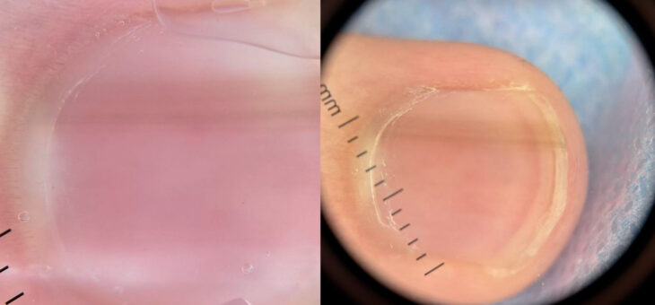 Тёмная полоска на ногте — норма или опасный сигнал?