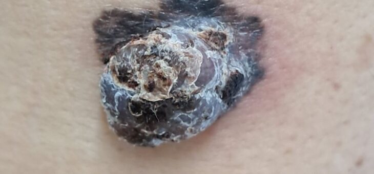 Меланома В Приднестровье